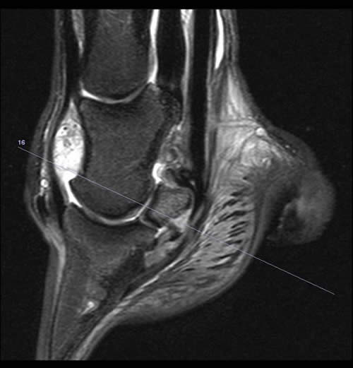 Sagittal 2D STIR