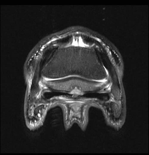 Transverse 2D STIR