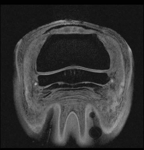 Tranverse 3D Flash MRI